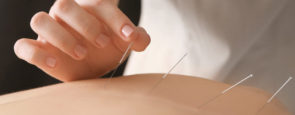 Benefits of acupuncture treatment