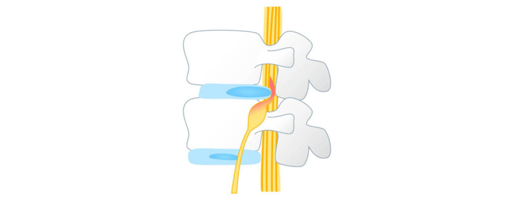 Can Physiotherapy Help Herniated Discs?