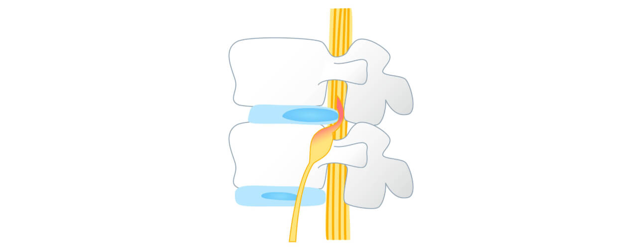 Can Physiotherapy Help Herniated Discs? - Peak To Shore Physiotherapy ...